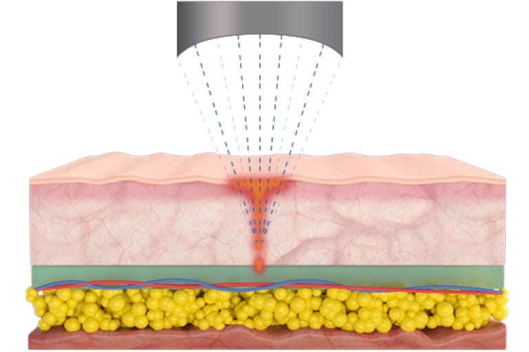 Hifu Focus Dual 10 Rectangle 10 1 AA Pro - Kokybiška Eunsung įranga