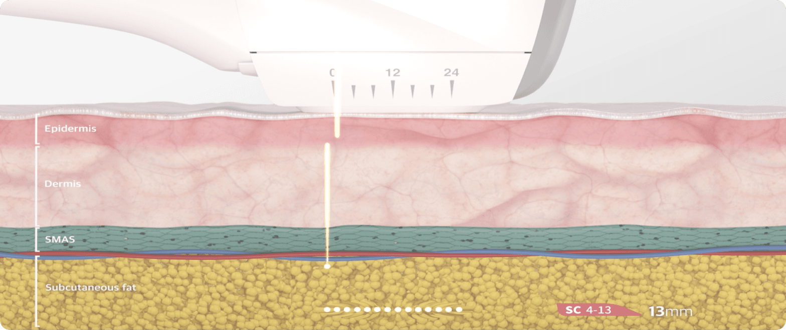 Hifu Focus Dual 12 Rectangle 13 AA Pro - Kokybiška Eunsung įranga