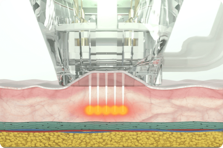 Hifu Focus Dual 7 Rectangle 7 AA Pro - Kokybiška Eunsung įranga