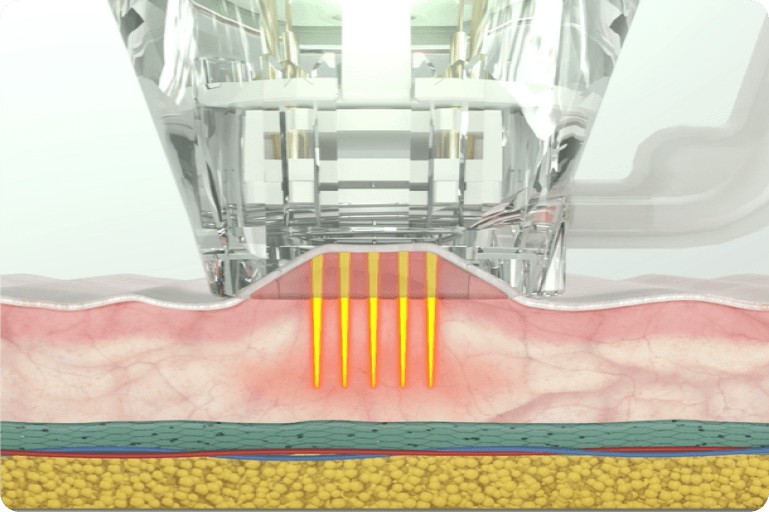 Hifu Focus Dual 8 Rectangle 8 AA Pro - Kokybiška Eunsung įranga