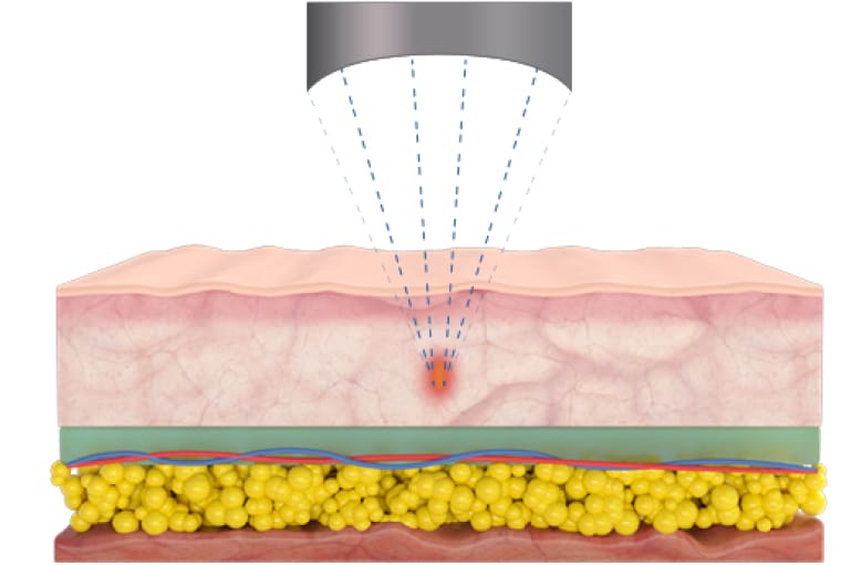 Hifu Focus Dual 11 Rectangle 9 AA Pro - Kokybiška Eunsung įranga