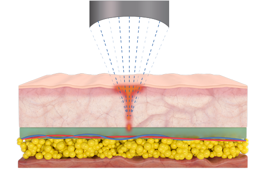 Microson HIFU 2 hifu focus dual tech 01 AA Pro - Kokybiška Eunsung įranga