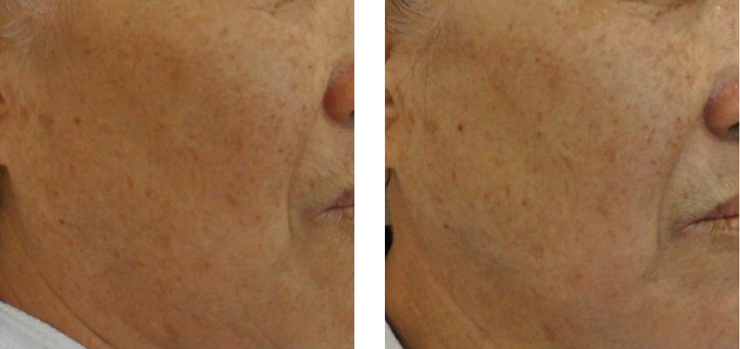 Age: 60s Treatment: 1 times