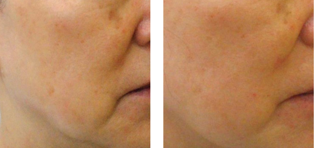 Age: 50s Treatment: 1 times