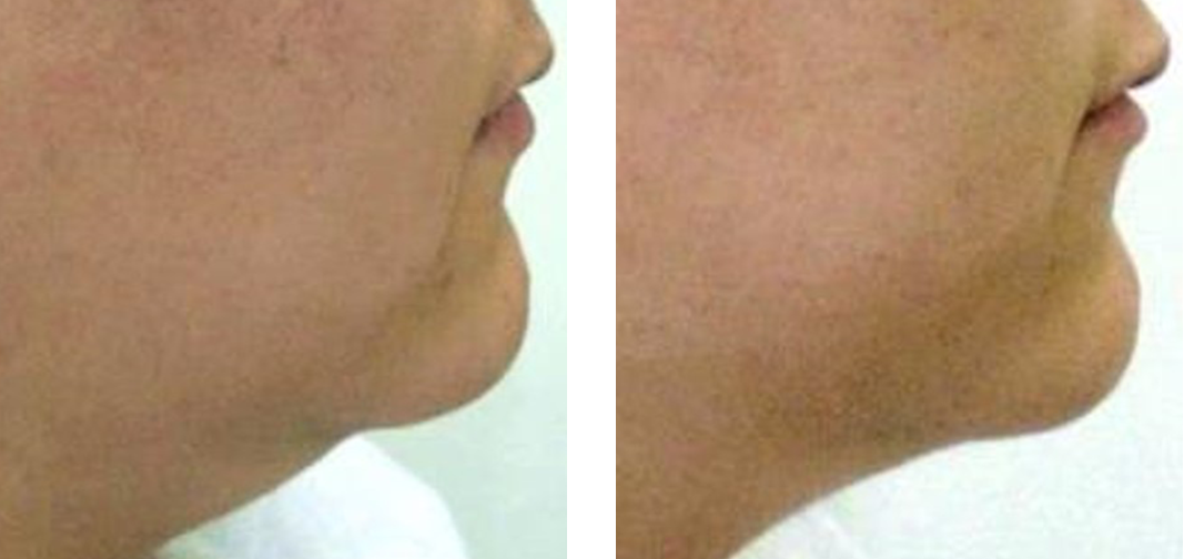 Age: 20s Treatment: 2 times